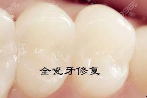 国产全瓷牙冠唯美视频,见证口腔美学新篇章